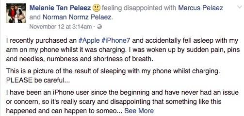 悉尼孕妇睡觉时被 iPhone 7烧伤，当时手机正在充电