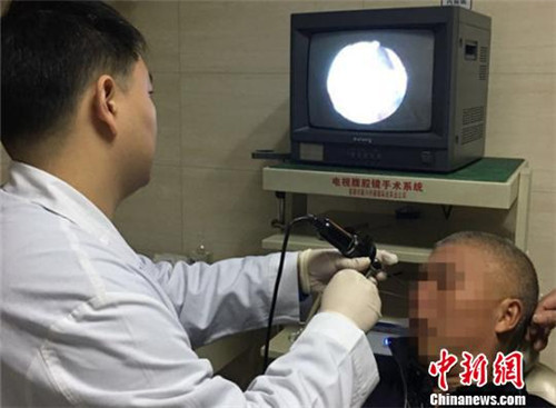 男子鼻腔取出螞蝗 鼻腔異物應如何處理