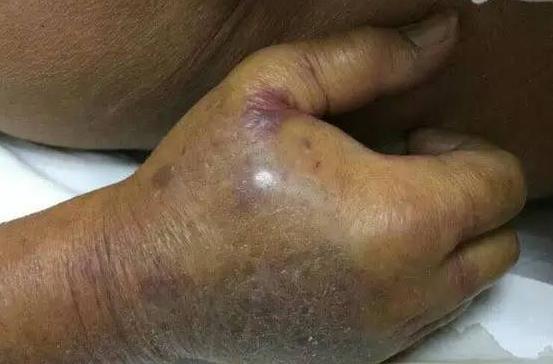 老人被蟹鉗傷身亡 細菌資料嚇呆眾網友！