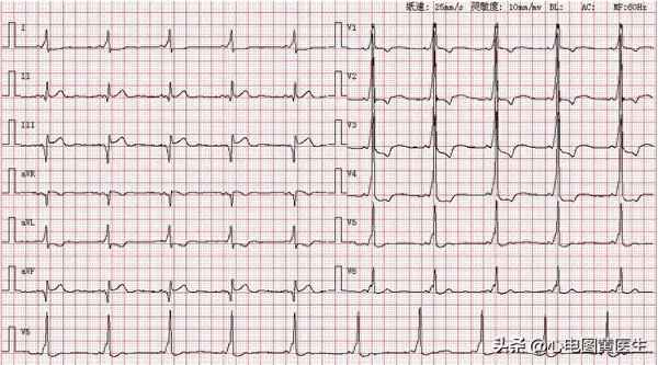 异常q波的临床表现_异常q波如何治疗