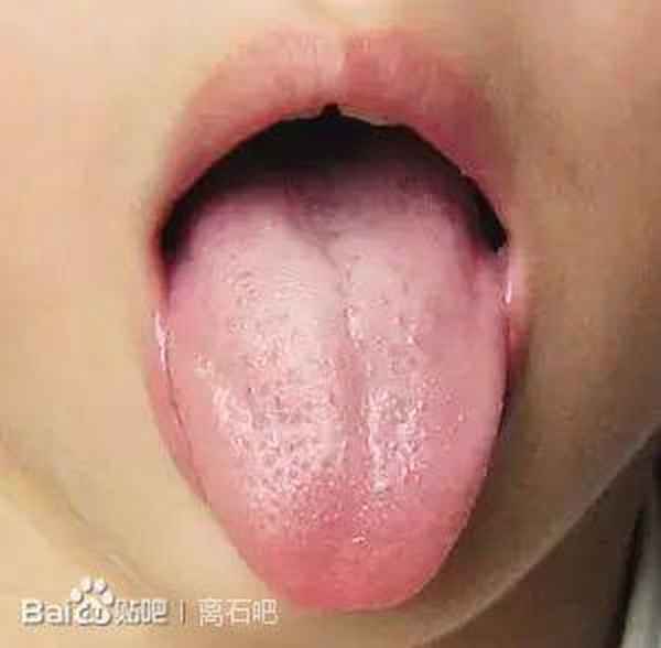 舌頭什么顏色是健康的圖片-舌頭什么顏色是健康的圖片吃什么可以去濕