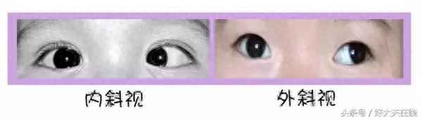 小孩是不是都有点对眼;小孩眼睛是对眼可以治好吗 - 两性健康 - 华网，华网资讯，华网头条，华人网络家园