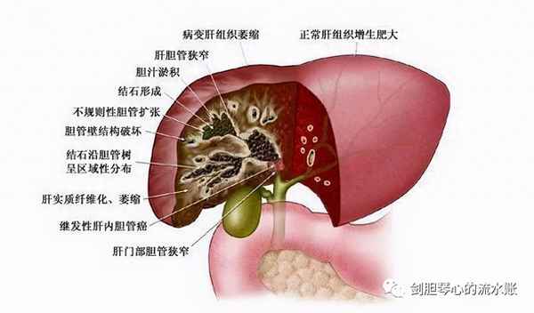 肝内胆管结石能活几年,70%人有肝内胆管结石