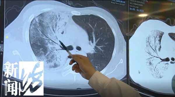 肺部感染最难治的细菌,肺部消炎最快最好方法