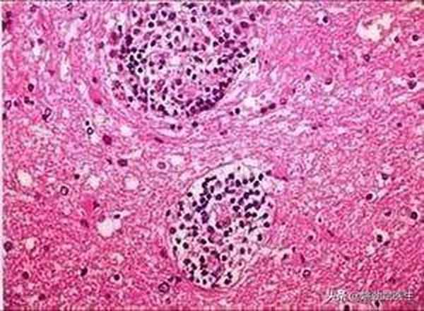 健康的肉芽组织,健康的肉芽组织对细菌的侵入有抵抗力吗