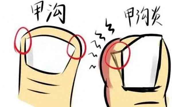 偏指甲红肿长在了肉里怎么办,手指甲边缘肉一碰就疼
