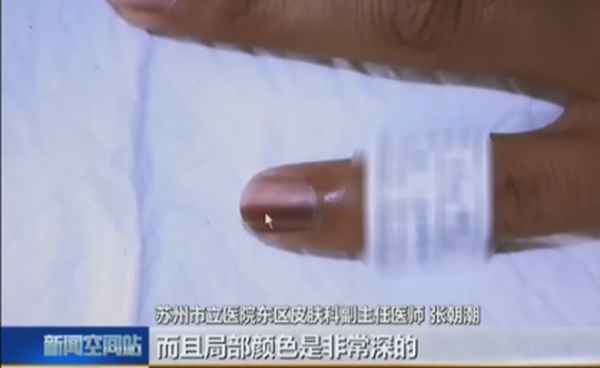 指甲前端发黑像脏了;指甲前端黑色像污垢