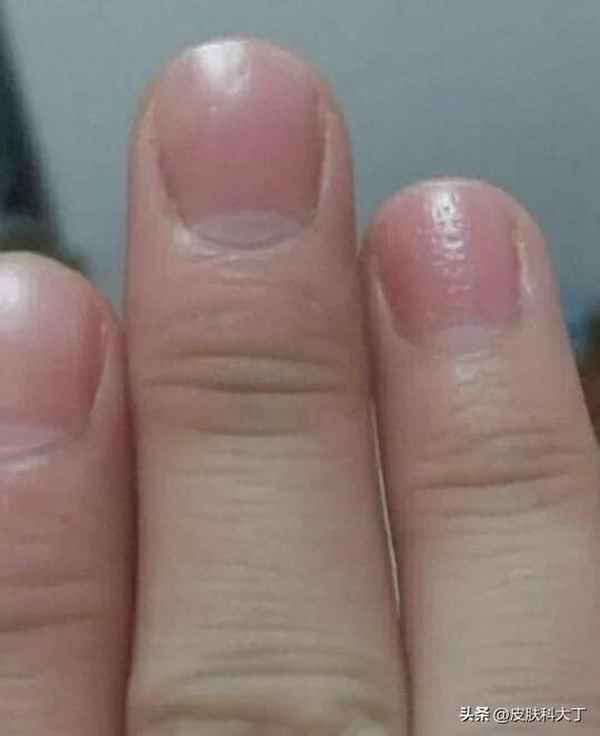 手指盖上有凹坑怎么回事-手指盖上有凹坑怎么回事儿
