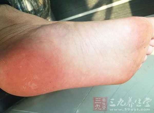 明矾治疗脚气的最佳方法_我用偏方治好了30年的皮癣