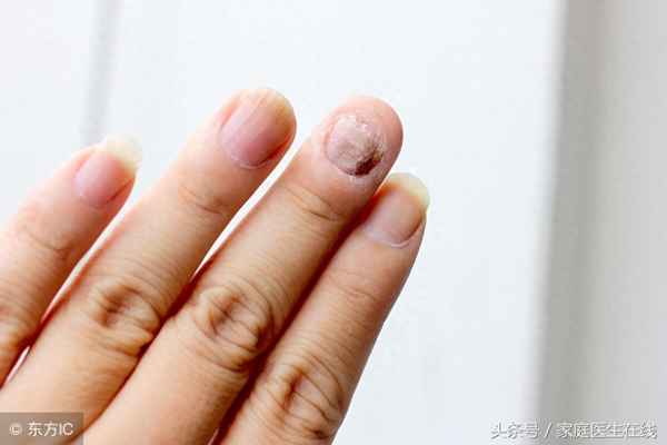 好多人灰指甲都不治、灰指甲慢慢变好的迹象