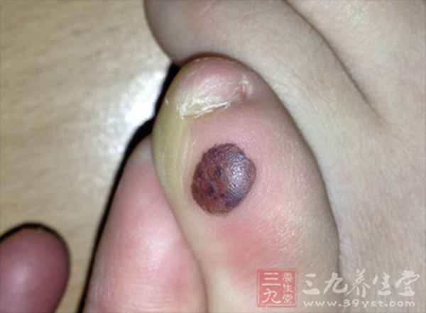 脚大拇指有黑块是怎么回事(脚的大拇指有黑块但无疼痛感)