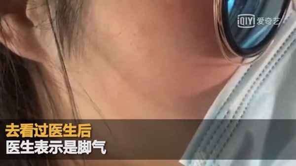 腳氣不會傳染到臉上吧_腳氣會傳染臉上嗎z