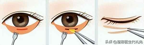 眼袋手术内切和外切哪个好-做眼袋的10大危害