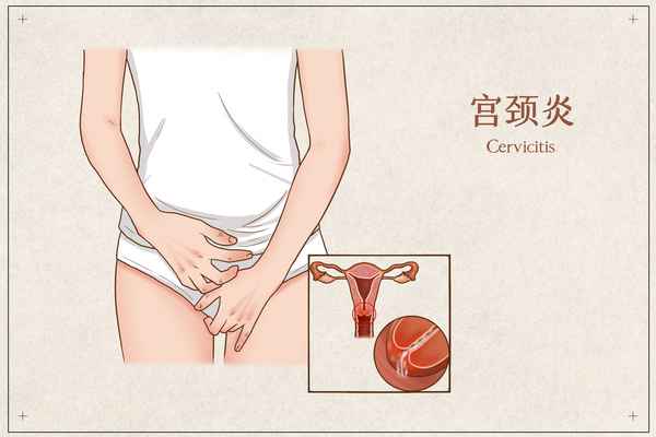 宮頸炎不治療會自愈嗎—婦科炎癥自測對照表