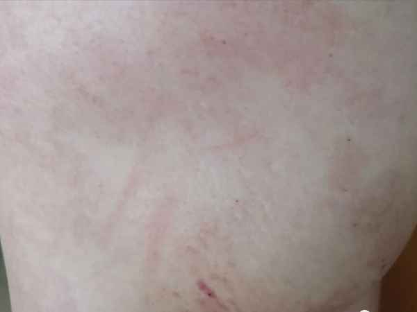 怎么判斷阿奇霉素過敏(吃阿奇過敏的疹子圖片)