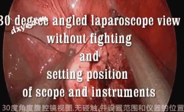 胆囊腹腔镜手术打孔位置图解—腹腔镜胆囊打孔地方要拆线吗