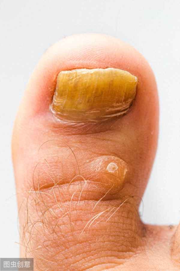 指甲表面像脱皮一样-指甲上能撕掉一层薄薄的皮