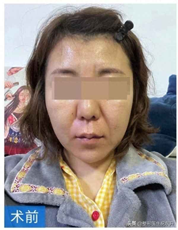 拉皮肉絲熱量高嗎、拉皮肉絲用什么樣的拉皮
