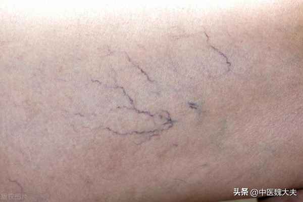 红血丝是怎么造成的_红血丝怎么形成的原因