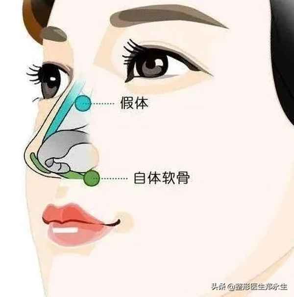 注射隆鼻都有什么材料,注射隆鼻都有什么材料啊 - 健康资讯 - 华网,华网资讯,华网头条,华人网络家园