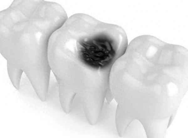 治疗牙疼吃罗转霉素管用吗-克拉霉素可以治牙疼消炎吗