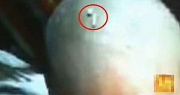 男子头部有出虫来;头上出虫子男孩治好了吗