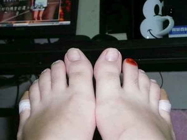 水泡型脚气的症状图片-脚上长一堆透明小水泡