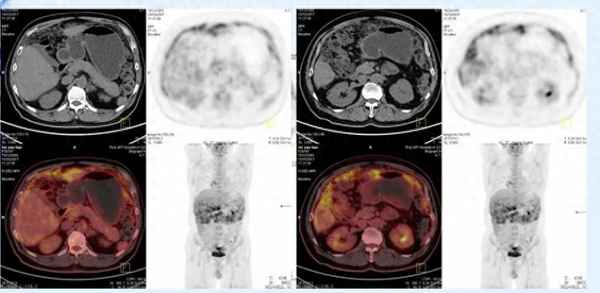 老人得了癌症晚期—老人得了癌症晚期怎么办
