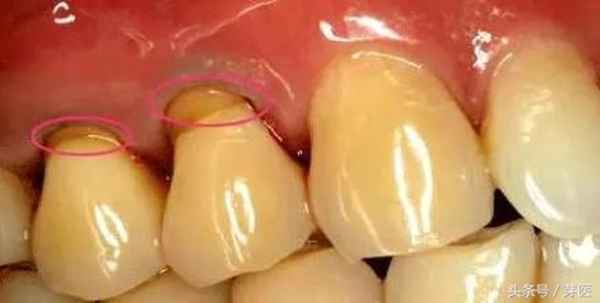 牙龈与牙齿连接处一碰就疼(牙龈和牙齿连接处碰牙齿会酸)