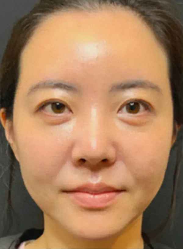 八大處楊欣微創(chuàng)懸吊;楊欣的微創(chuàng)懸吊術(shù)怎么樣