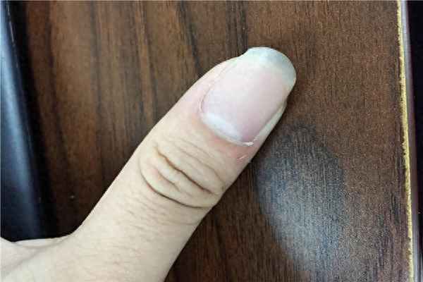 大拇指指甲盖凹下去是什么原因—大拇指甲盖凹下去了怎么回事