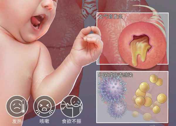 支气管肺炎快好的征兆-支气管肺炎快好的征兆还要几天好