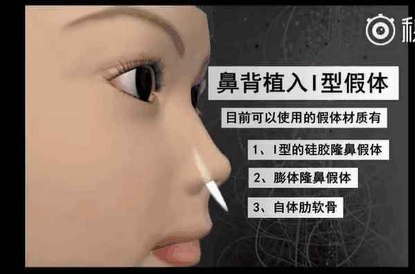 假体隆鼻用什么材料比较好、l型假体隆鼻可以保持几年