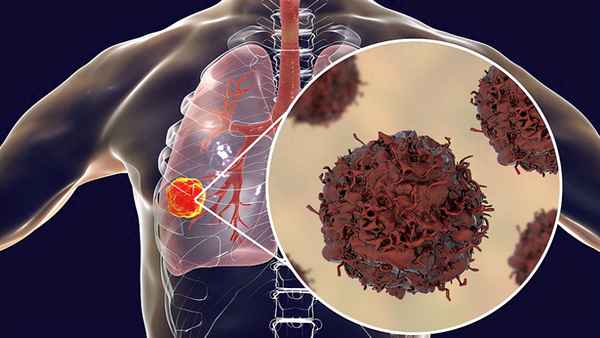 肺癌早期八个信号-肺癌晚期最怕三个征兆