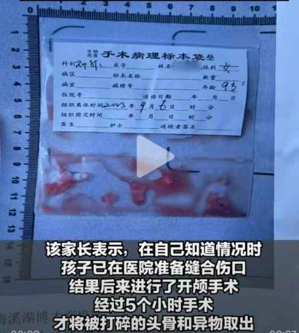 被擊打頭部會導致什么—頭被擊打會怎么樣