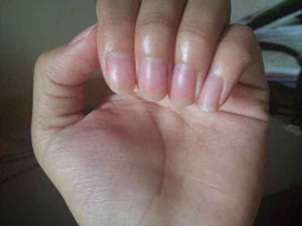 单独一个指甲凹凸不平(指甲上好多坑坑洼洼的小坑)