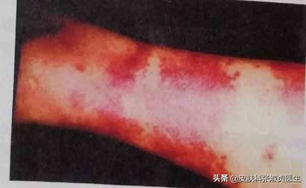 丹毒怎么彻底治疗_腿部丹毒最好治疗方法 - 名医在线 - 华网