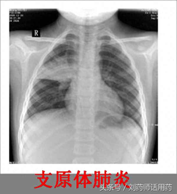 兒童肺炎掛了7天阿奇霉素;兒童肺炎掛了7天阿奇霉素后肺片會紋理增多嗎