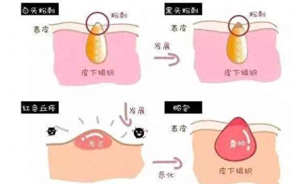 闭口粉刺是什么原因引起的、闭口粉刺是什么原因引起的图片